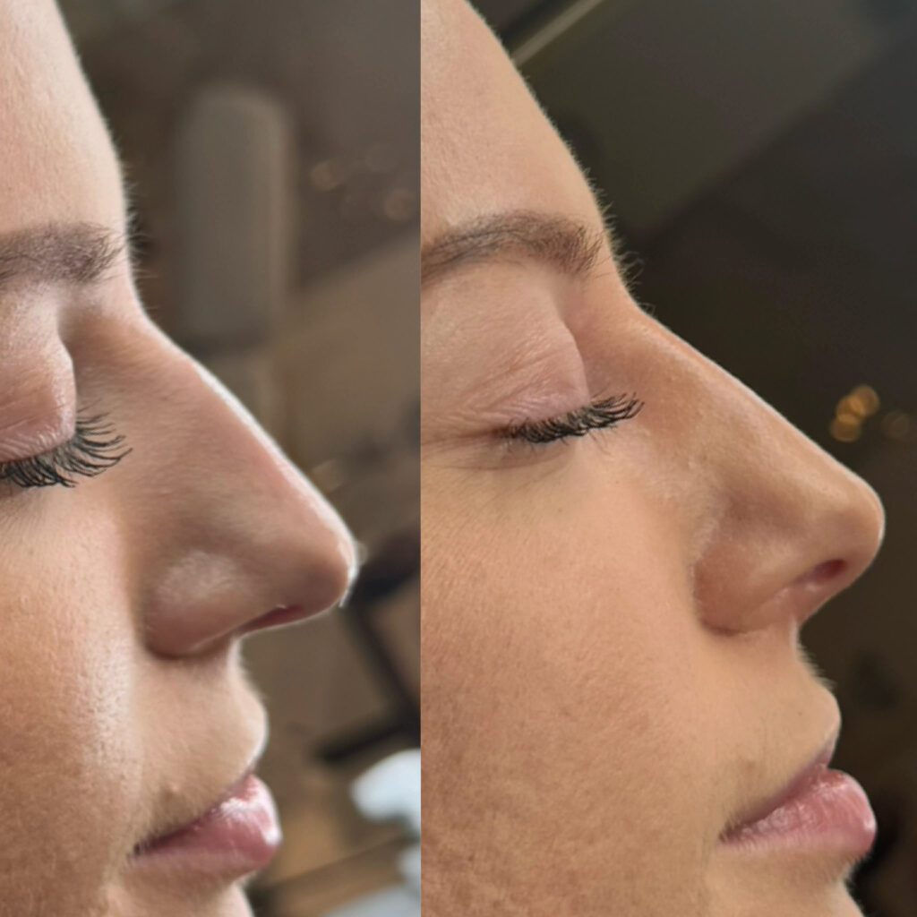 Niechirurgiczna korekta nosa kwasem hialuronowym. Medycyna estetyczna i zaawansowana wolumetria twarzy. Wyrównanie garbu i uniesienie czubka nosa. Zadowolona pacjentka z Olsztyna.