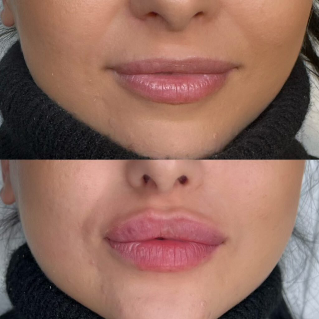 Piękne i naturalne efekty po zabiegu medycyny estetycznej - powiększanie ust kwasem hialuronowym. Zdjęcie przed i po zabiegu powiększania i wyrównania ust. Zadowolona pacjentka z gabinetu w Olsztynie.