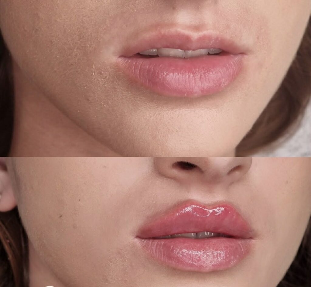 Piękne i naturalne efekty po zabiegu medycyny estetycznej - powiększanie ust kwasem hialuronowym. Wyrównanie wielkości obu warg. Zadowolona pacjentka z gabinetu w Olsztynie.