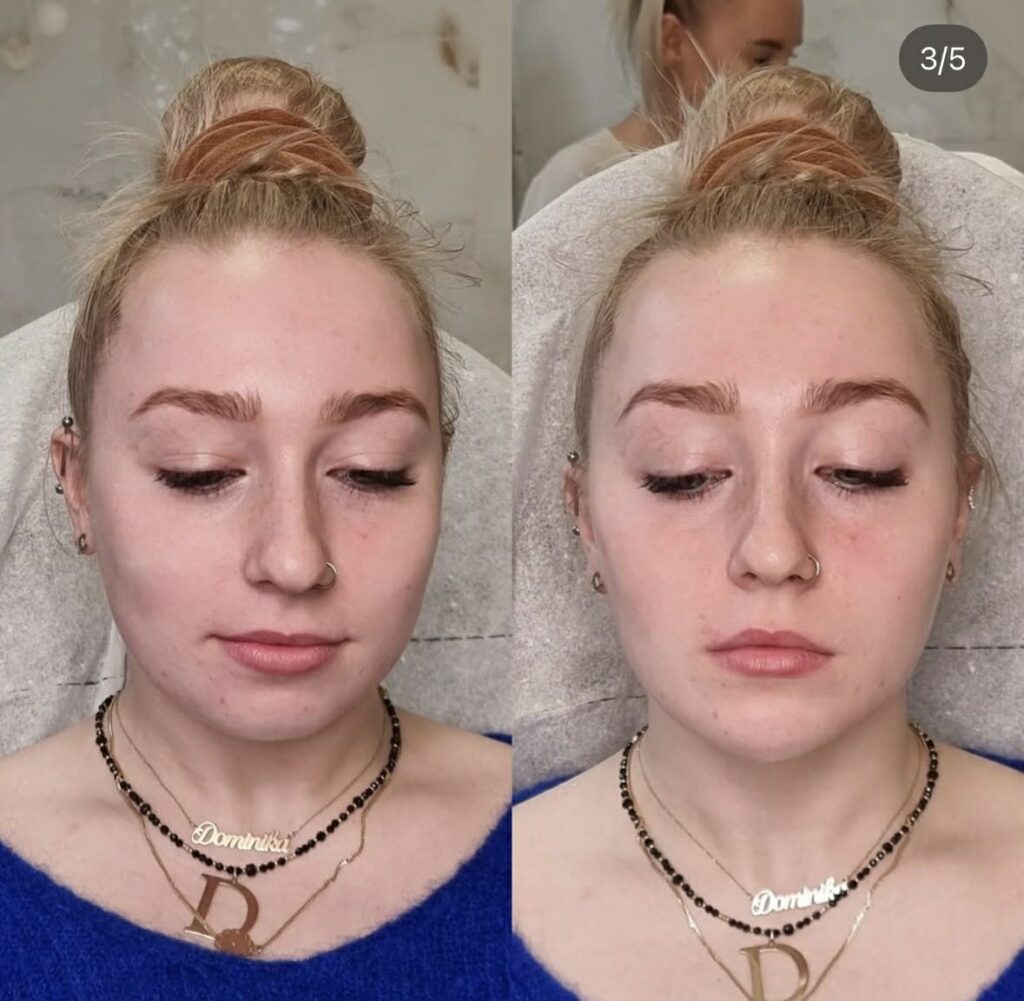 Wolumetria twarzy i poprawa owalu brody. Nowoczesna medycyna estetyczna bez skalpela. Widoczne odmłodzenie rysów twarzy pacjentki i wydłużenie brody z Olsztyna.