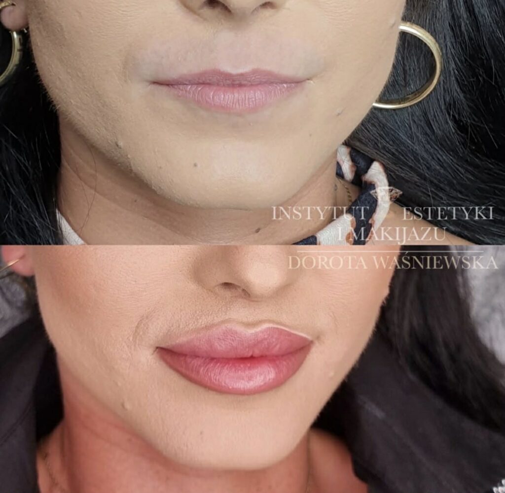 Piękne i naturalne efekty po zabiegu medycyny estetycznej - powiększanie ust kwasem hialuronowym. Zdjęcie przed i po zabiegu. Zadowolona pacjentka z gabinetu w Olsztynie.