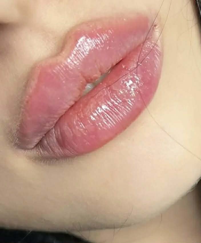 Piękne i naturalne efekty po zabiegu medycyny estetycznej - powiększanie ust certyfikowanym kwasem hialuronowym. Zadowolona pacjentka po wykonaniu zabiegu