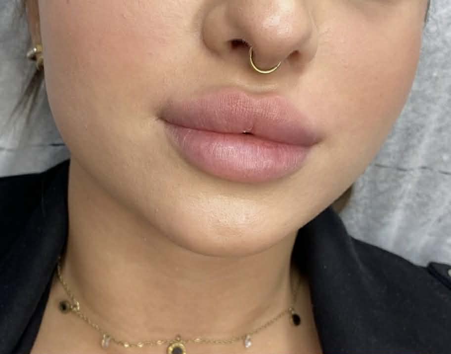 Piękne i naturalne efekty po zabiegu medycyny estetycznej - powiększanie ust kwasem hialuronowym. Zadowolona pacjentka z gabinetu w Olsztynie.